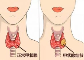 甲状腺结节的原因是什么?
