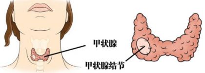 甲状腺结节多大要手术？