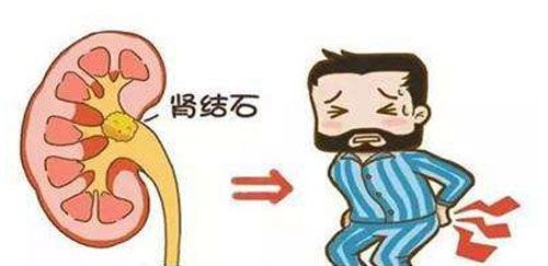 肾结石有哪些表现？