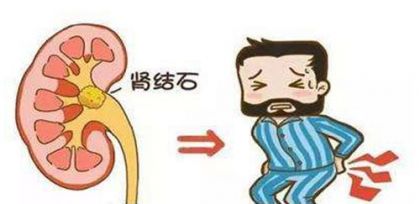 肾结石有哪些表现？