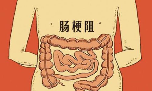 什么是肠梗阻？肠梗阻的症状有哪些？