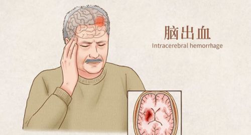 诊断脑出血(脑溢血)的方法有哪些 脑出血饮食方面要注意什么