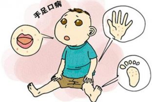 手足口病初期症状 手足口病要做哪些检查