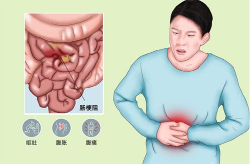 肠梗阻的主要症状表现是什么?