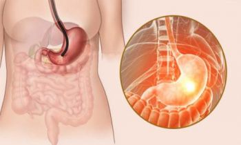 胃癌的症状 胃癌如何预防