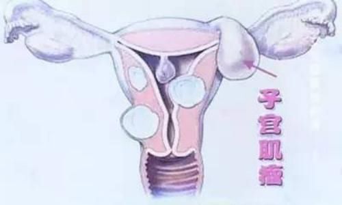 子宫肌瘤如何治疗 子宫肌瘤的危害有哪些