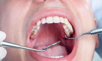 洗牙的危害有哪些？洗牙后的注意事项