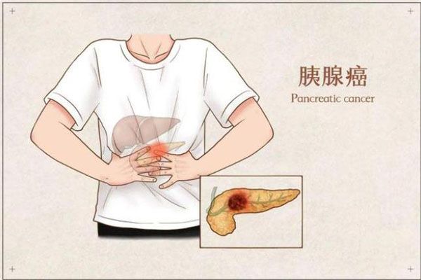 胰腺癌为什么被称为万癌之王？