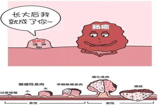 肠息肉的症状有那些？怎么预防肠息肉