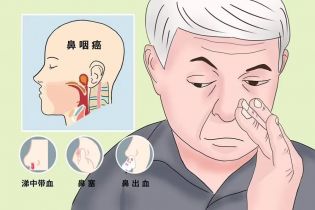 鼻咽癌早期症状表现！五类人群最高危，体检筛查主要这三项