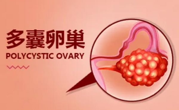 多囊卵巢综合症是什么？女性体检应该注意什么？